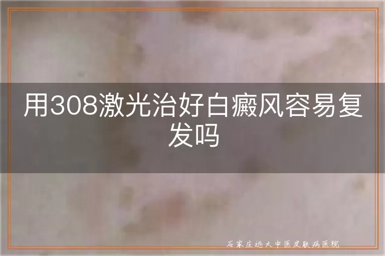 用308激光治好白癜风容易复发吗