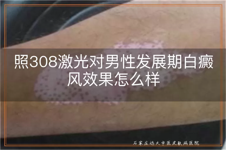 照308激光对男性发展期白癜风效果怎么样