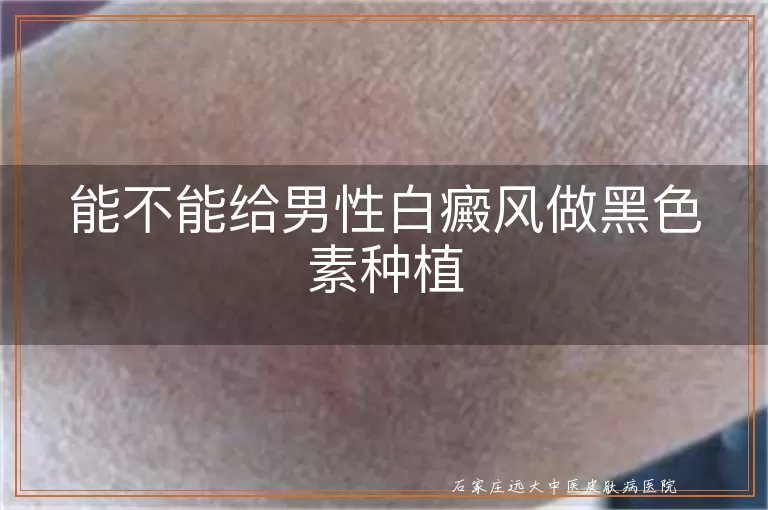 能不能给男性白癜风做黑色素种植