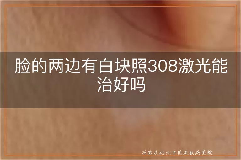 脸的两边有白块照308激光能治好吗