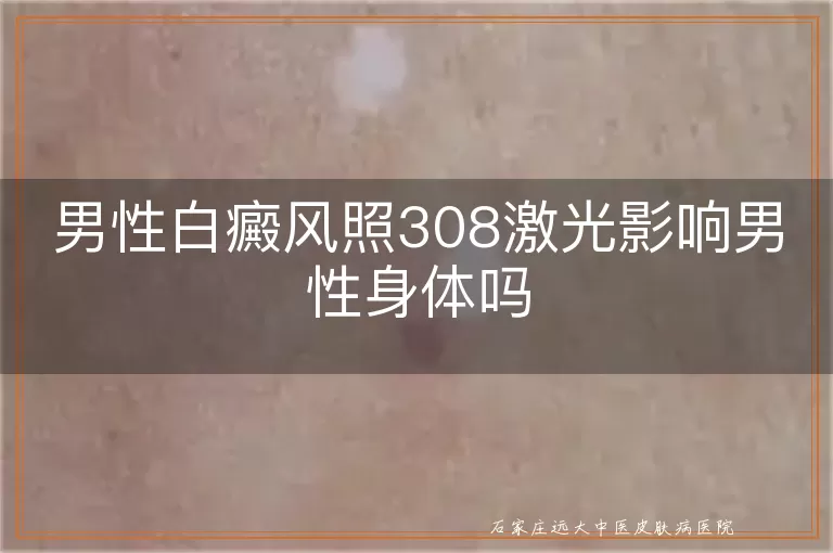 男性白癜风照308激光影响男性身体吗