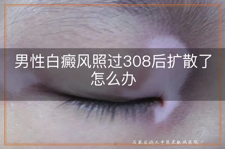 男性白癜风照过308后扩散了怎么办