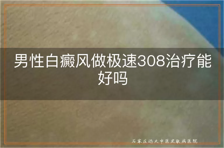 男性白癜风做极速308治疗能好吗