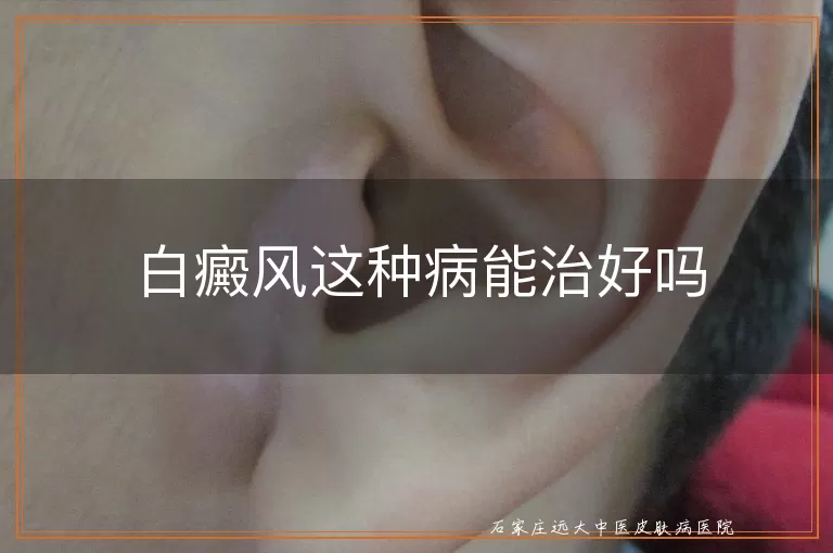 白癜风这种病能治好吗