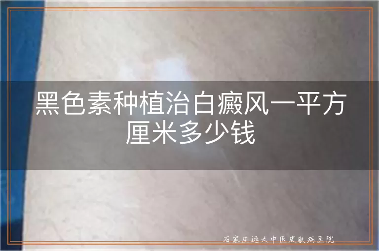 黑色素种植治白癜风一平方厘米多少钱