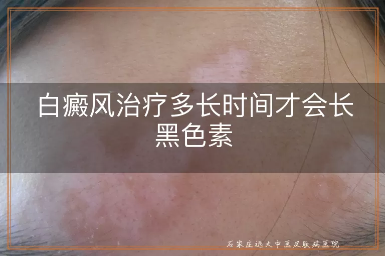 白癜风治疗多长时间才会长黑色素