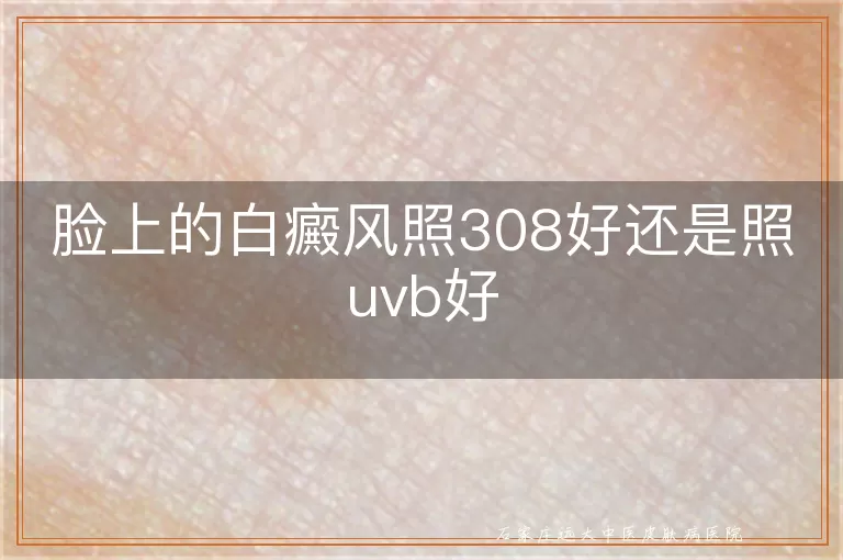 脸上的白癜风照308好还是照uvb好