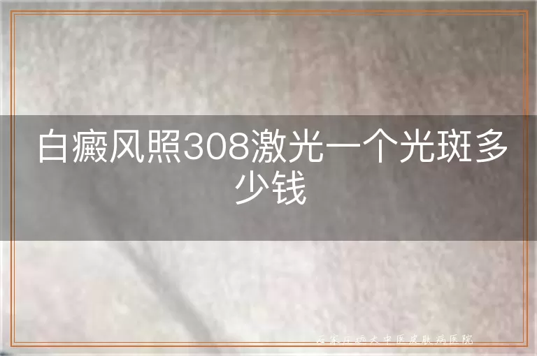 白癜风照308激光一个光斑多少钱