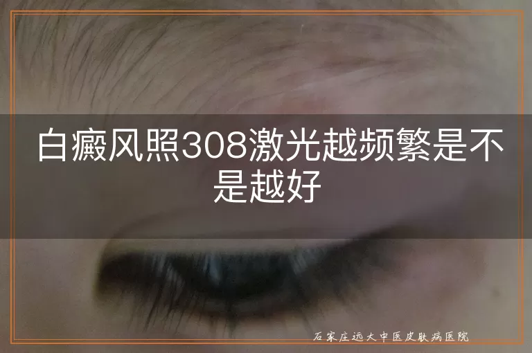 白癜风照308激光越频繁是不是越好