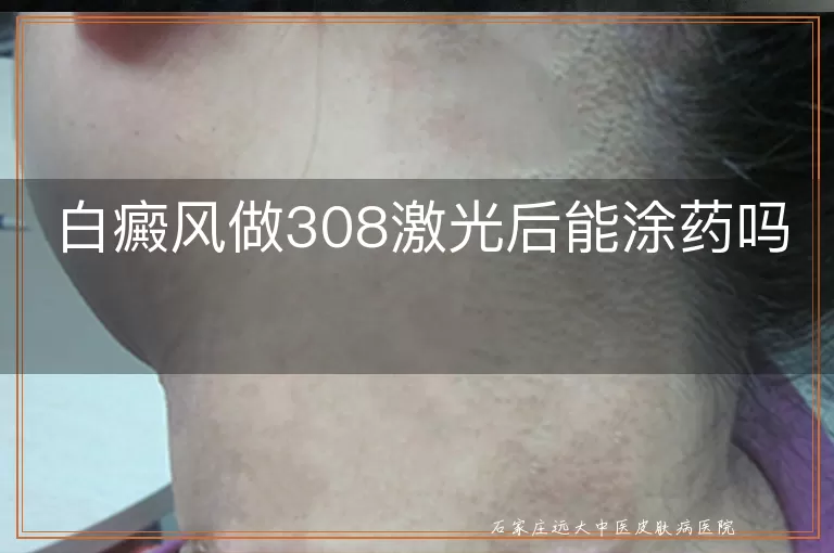 白癜风做308激光后能涂药吗