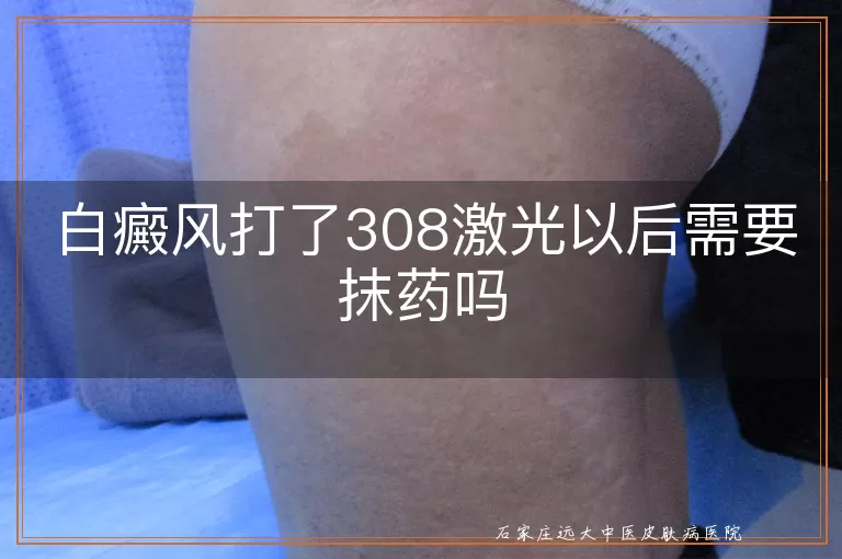 白癜风打了308激光以后需要抹药吗