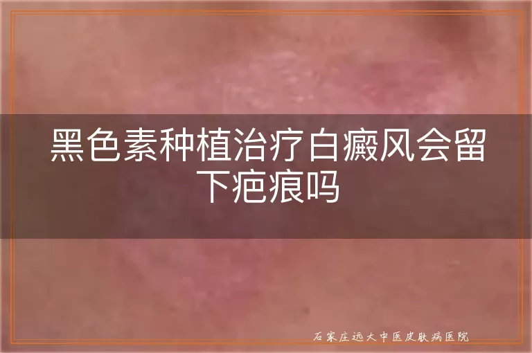 黑色素种植治疗白癜风会留下疤痕吗