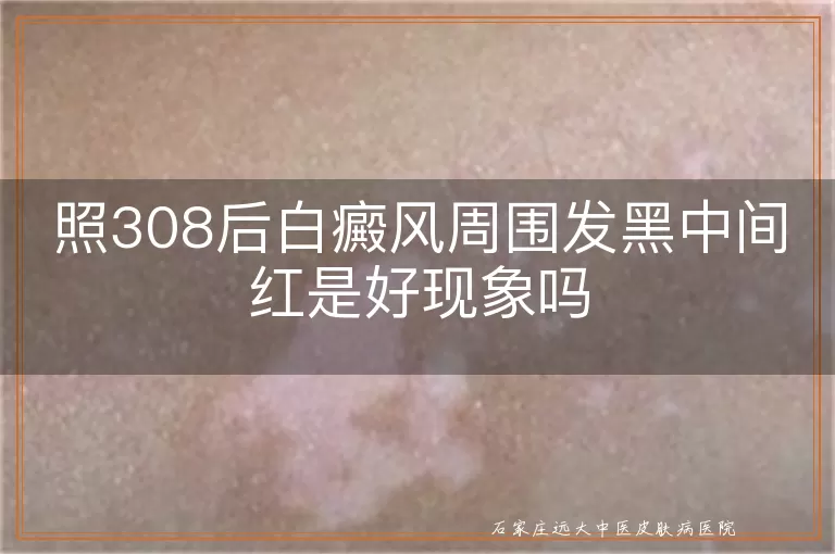 照308后白癜风周围发黑中间红是好现象吗