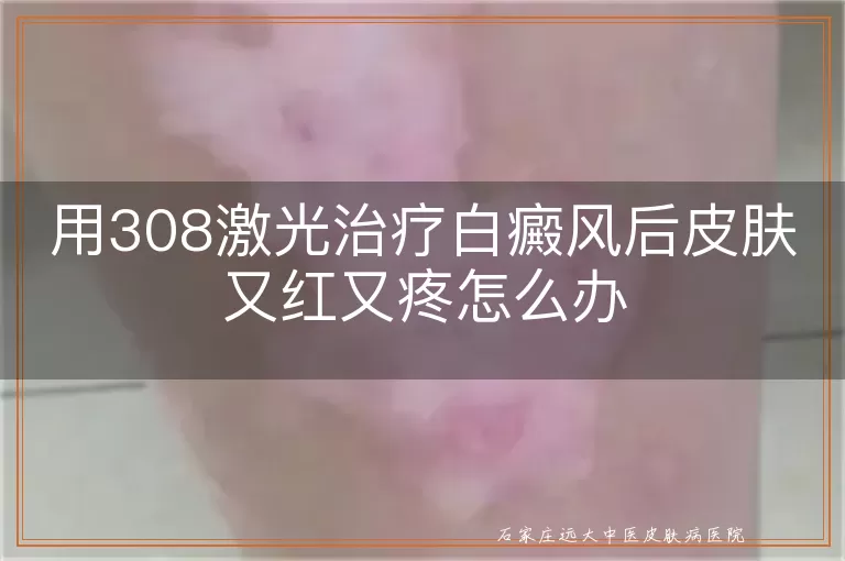 用308激光治疗白癜风后皮肤又红又疼怎么办
