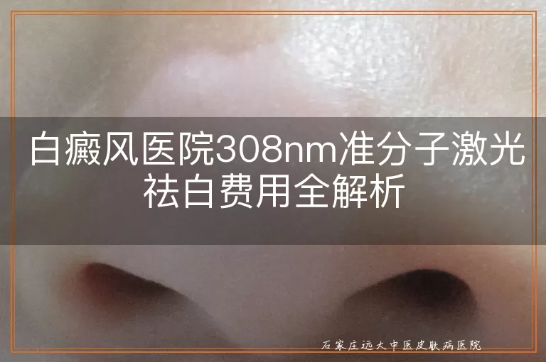 白癜风医院308nm准分子激光祛白费用全解析