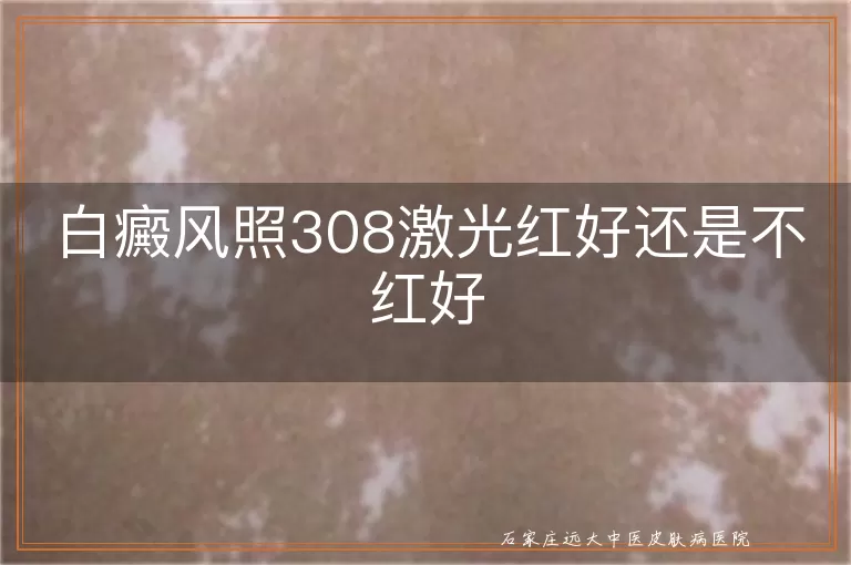 白癜风照308激光红好还是不红好
