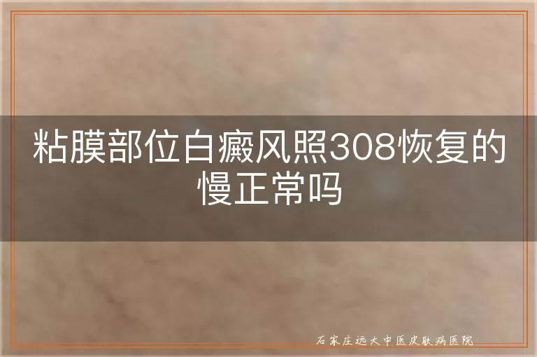 粘膜部位白癜风照308恢复的慢正常吗