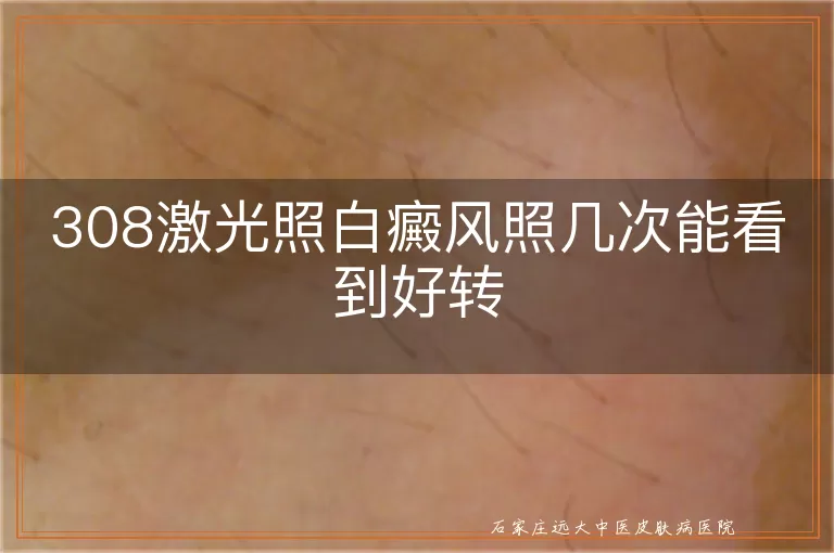 308激光照白癜风照几次能看到好转