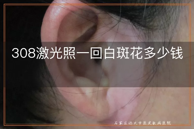 308激光照一回白斑花多少钱