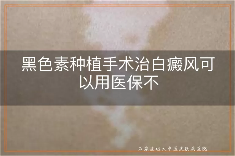 黑色素种植手术治白癜风可以用医保不