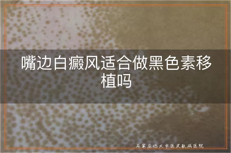 嘴边白癜风适合做黑色素移植吗