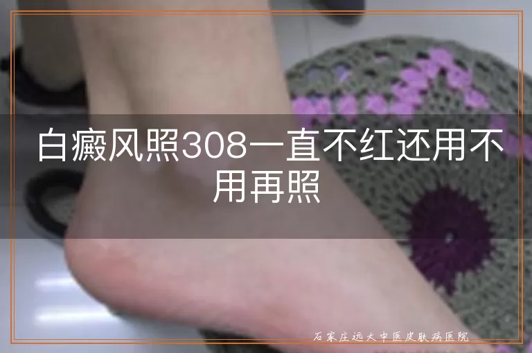 白癜风照308一直不红还用不用再照