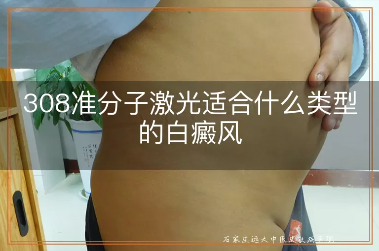 308准分子激光适合什么类型的白癜风