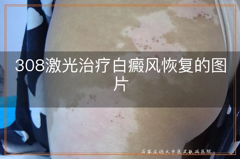 308激光治疗白癜风恢复的图片