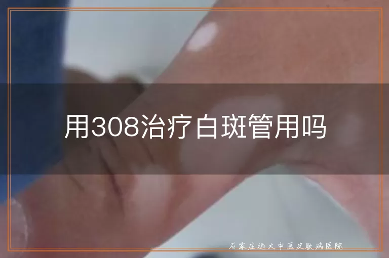 用308治疗白斑管用吗