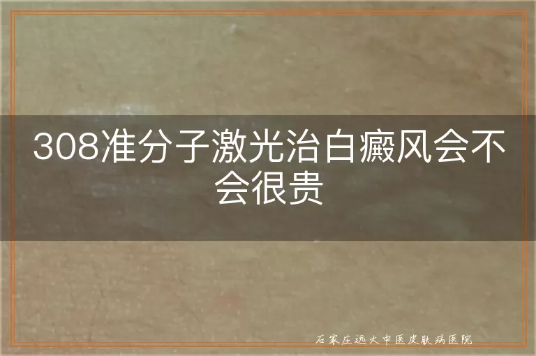 308准分子激光治白癜风会不会很贵