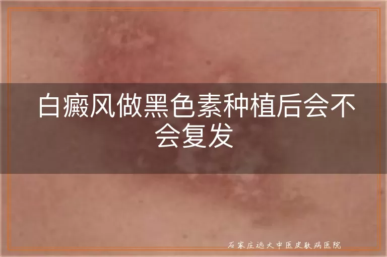 白癜风做黑色素种植后会不会复发