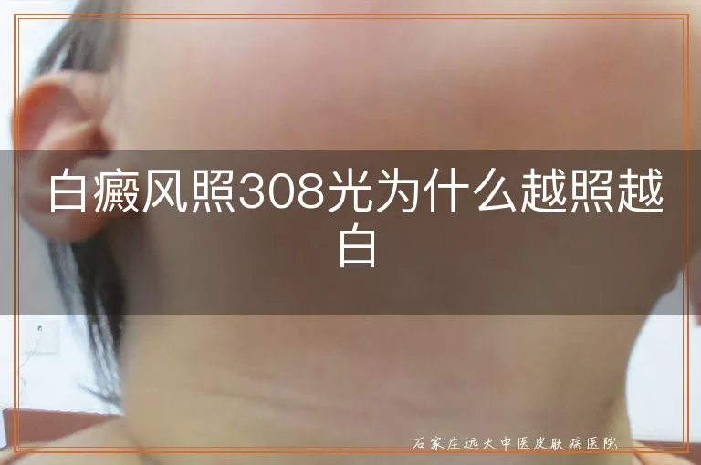 白癜风照308光为什么越照越白