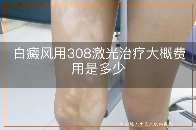 白癜风用308激光治疗大概费用是多少