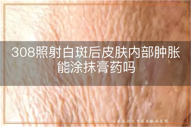 308照射白斑后皮肤内部肿胀能涂抹膏药吗