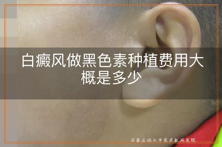 白癜风做黑色素种植费用大概是多少