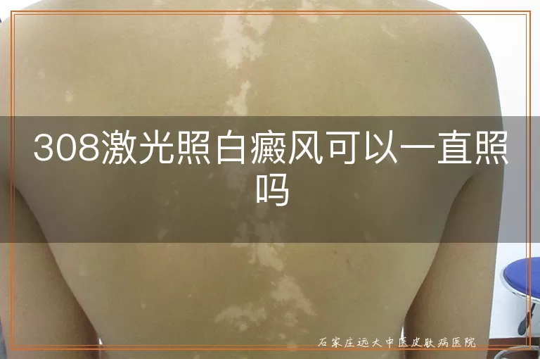 308激光照白癜风可以一直照吗