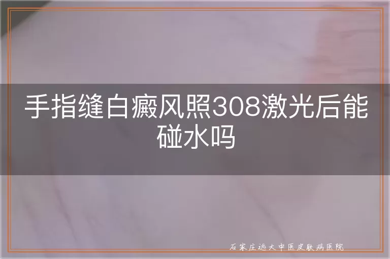 手指缝白癜风照308激光后能碰水吗