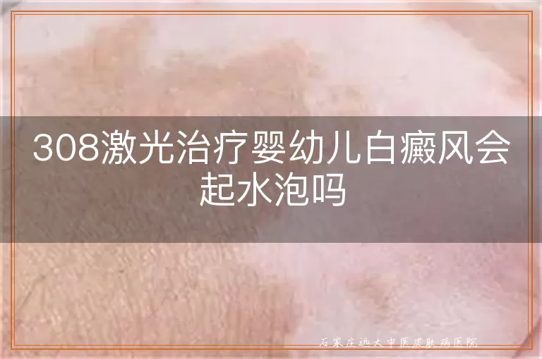 308激光治疗婴幼儿白癜风会起水泡吗