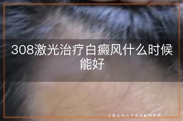 308激光治疗白癜风什么时候能好