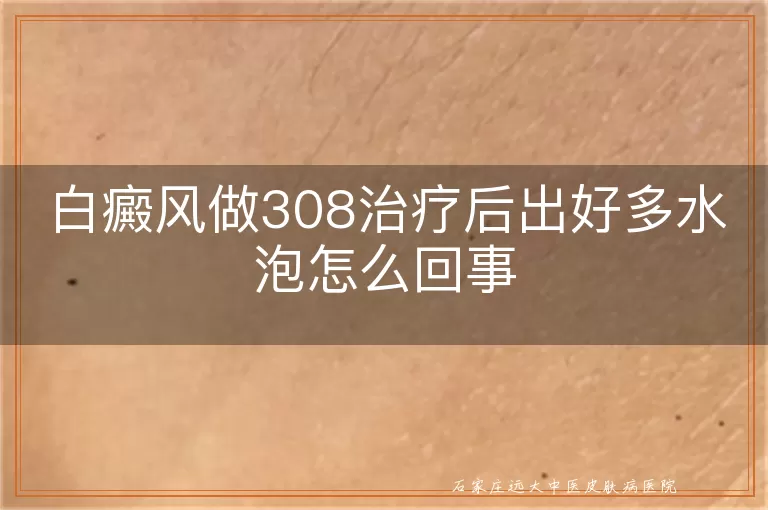 白癜风做308治疗后出好多水泡怎么回事