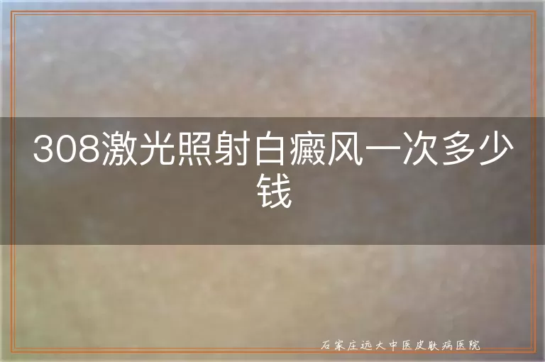 308激光照射白癜风一次多少钱