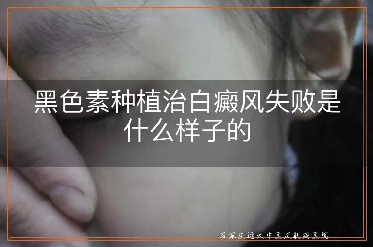 黑色素种植治白癜风失败是什么样子的