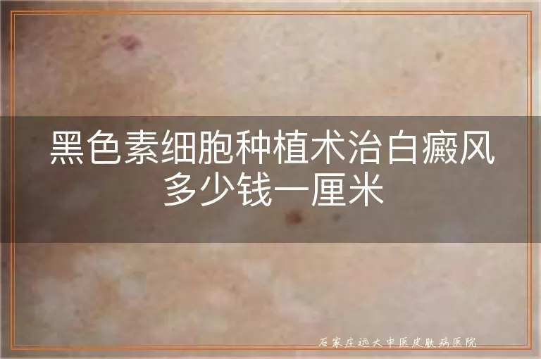 黑色素细胞种植术治白癜风多少钱一厘米