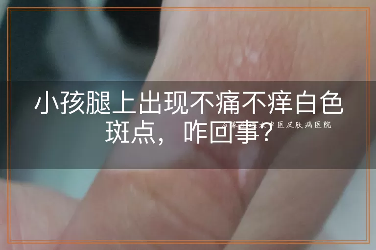 小孩腿上出现不痛不痒白色斑点,咋回事?