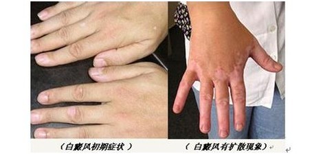 石家庄男性白癜风医院网上挂号预约