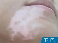 下巴白癜风白斑案例