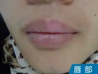 嘴唇白癜风白斑案例
