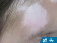 额头白癜风白斑案例