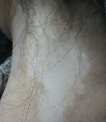 颈部白癜风白斑案例