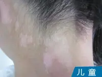 儿童颈部白癜风白斑案例